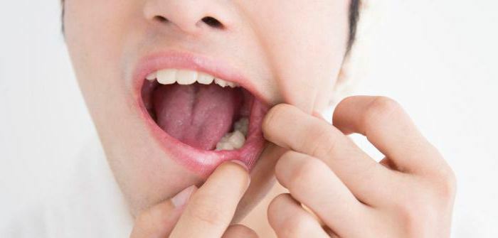 التهاب السمحاق من الفك السفلي بعد استخراج الأسنان