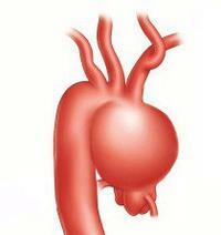 Aneurysm av den stigende aorta