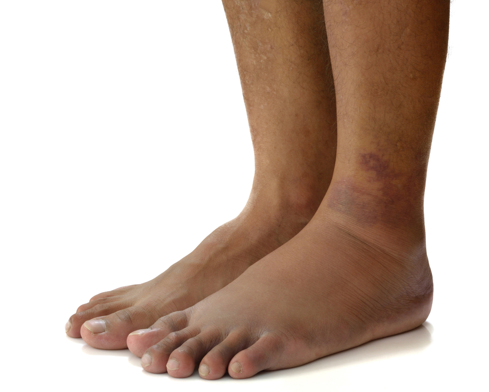 Edema of the feet with diabetes