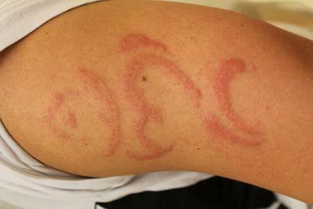 allergie au traitement au henné