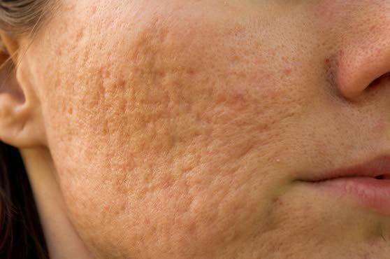 Consequences of cystic acne