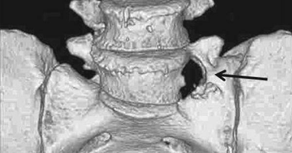 ufuldstændig sacralisering af 15 vertebra