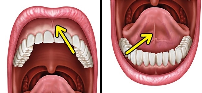 bridles in the oral cavity