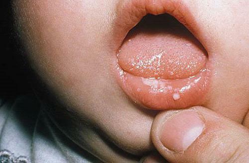 photo of rashes in the mouth