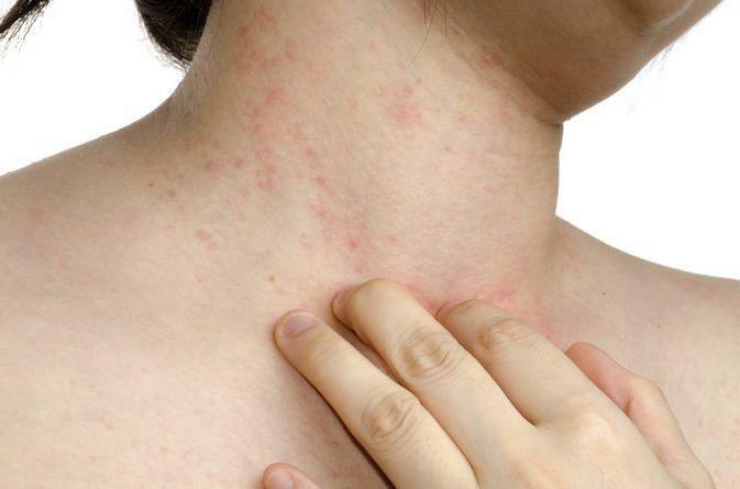alergija na vrat