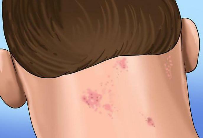 alergija na obraz in vrat