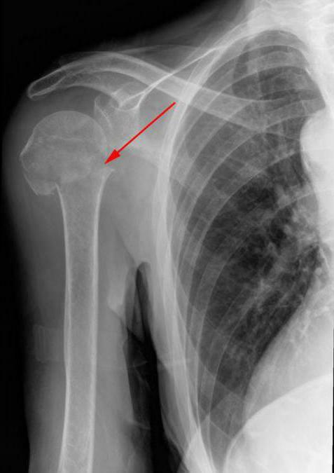 ארתרוזיס של מפרק הכתף גורם לסימפטומים של התואר