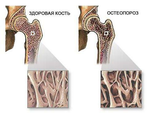 osteoporoza difuză a oaselor