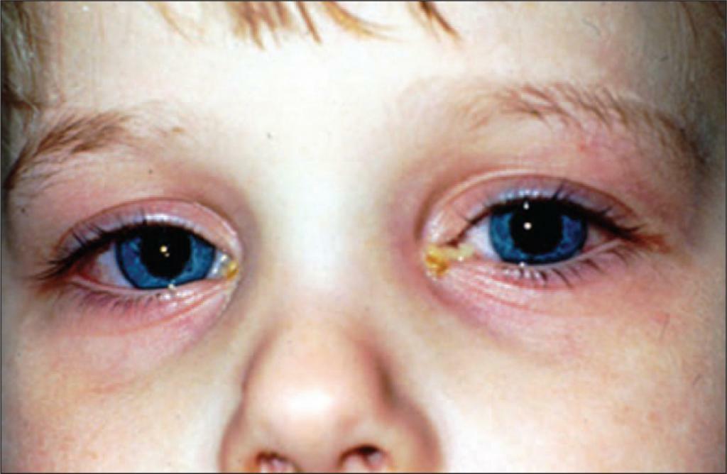 التهاب الملتحمة قيحي في الأطفال