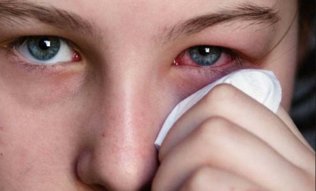 التهاب الملتحمة قيحي من العين
