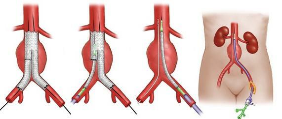 Aneurizma aorte želučane šupljine