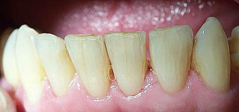 grietas en los dientes