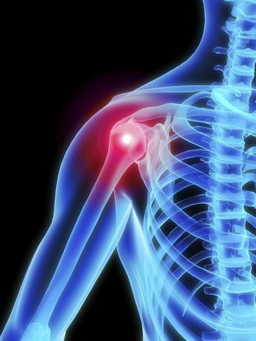 arthrosis של הכתף משותף סימפטומים וטיפול