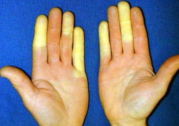 cross syndrome with scleroderma