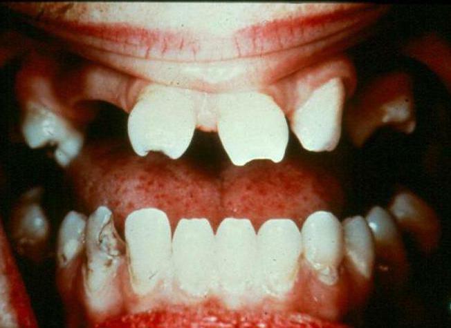 pelzige Zähne