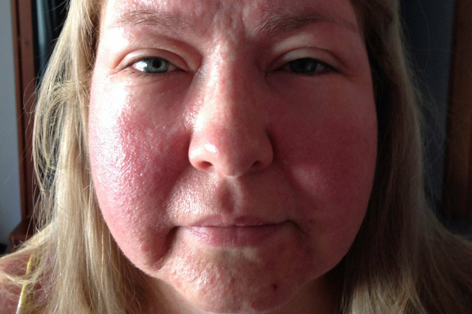 cutaneous manifestations of an allergic reaction