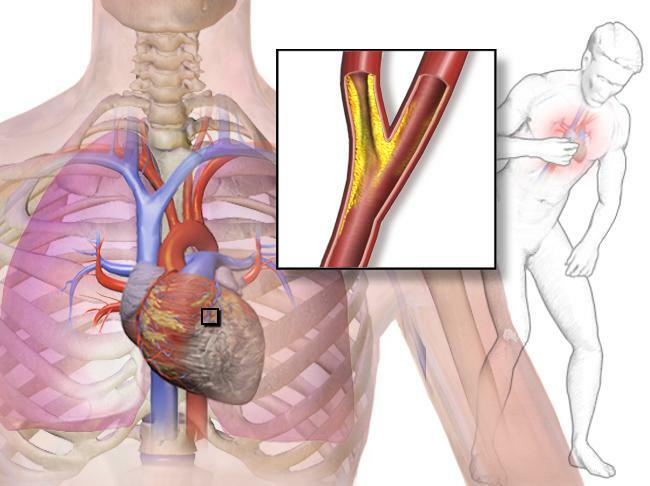 what to do in case of symptoms of angina pectoris