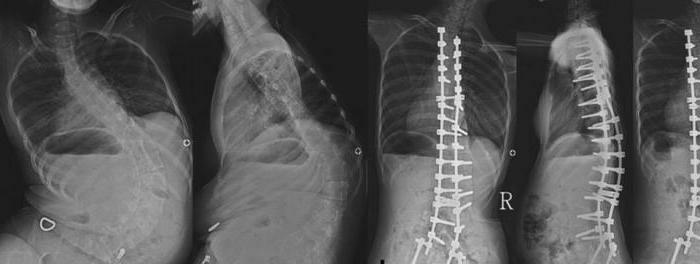 Spinale Muskelatrophie vom Typ 2