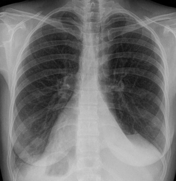atelettasia polmonare discoidale