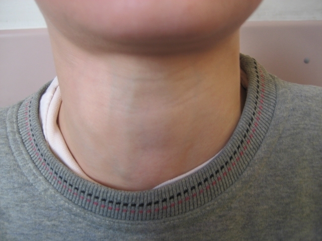 Swelling in the neck - a symptom of ectasia