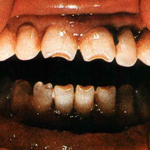 שיניים של שיניים