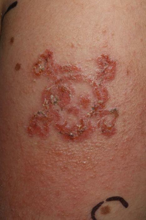Apakah alergi henna?