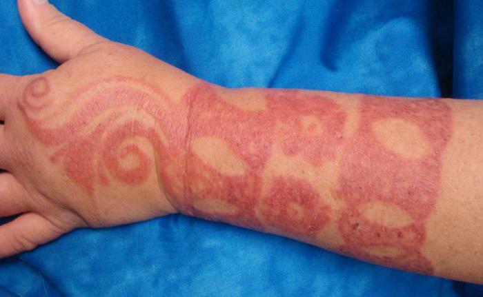 allergi over for henna