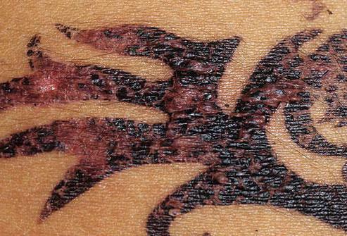 alerģija pret hennu, ko darīt