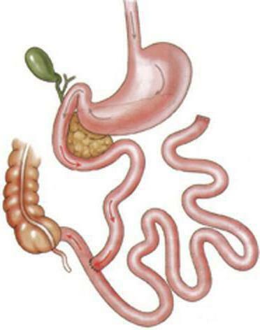 syndrome of the small intestine
