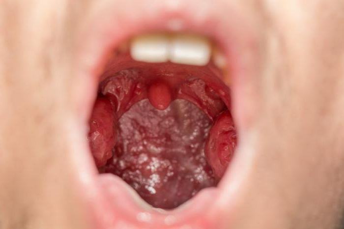 a small tongue in the throat