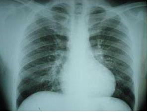 hemosiderosis of the lungs