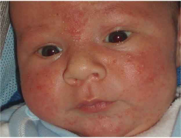 vesiculopustulosis in newborns