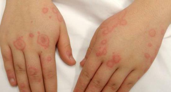 Rashes on the palms and soles of the child symptoms and causes