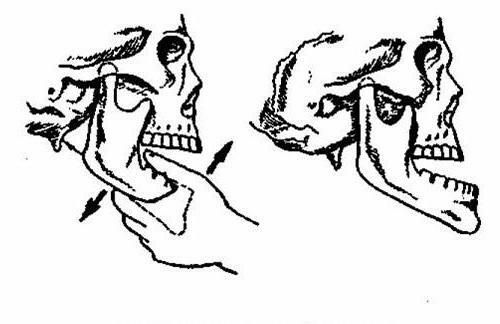 dislocation of the jaw