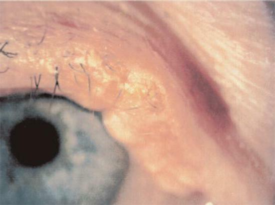 meibomian gland dysfunction