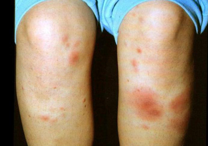 sarcoidosis skin symptoms