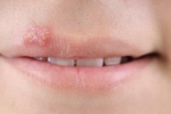 herpes treatment in adults