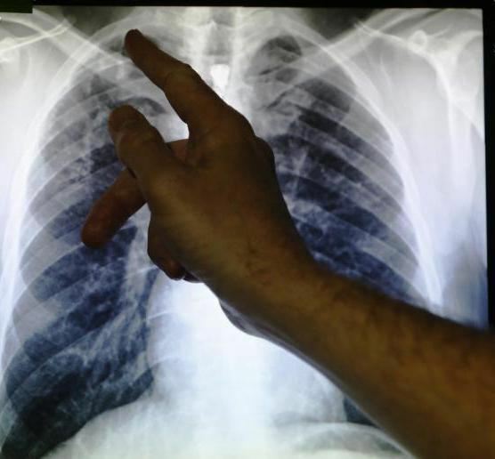 new drugs for tuberculosis