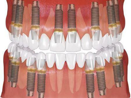 implant osstem