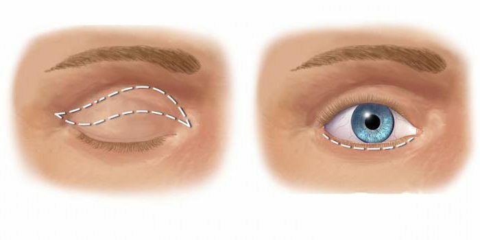 upper eyelid after blepharoplasty