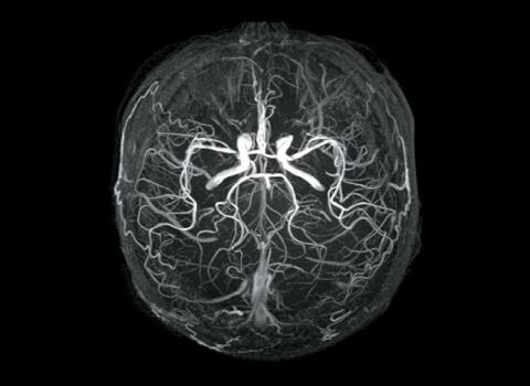 angioedemul cerebral al preparatelor de tratament ale vaselor cerebrale