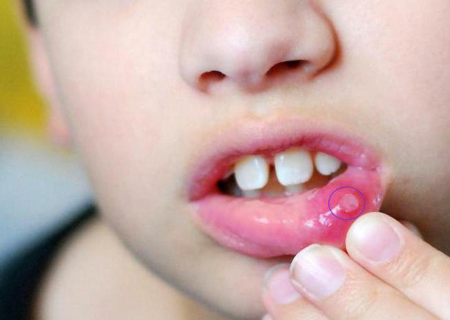 how long infectious is stomatitis