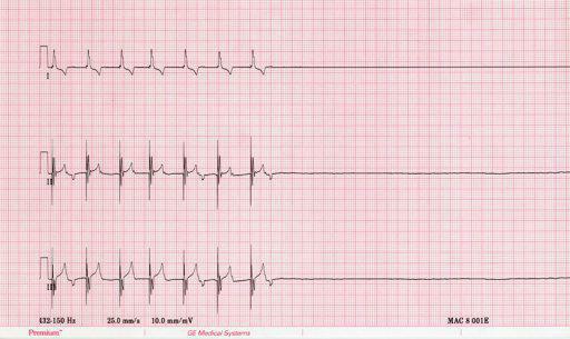 asystole of the heart on the ECG