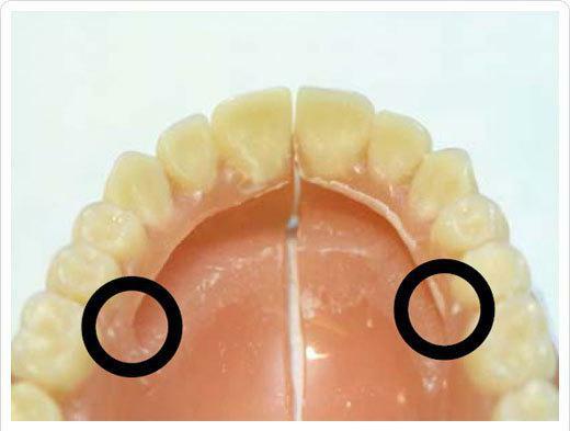 Repair of a removable denture
