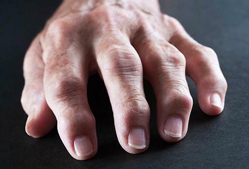 arthritis prophylaxis