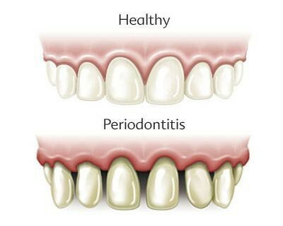 what is periodontitis