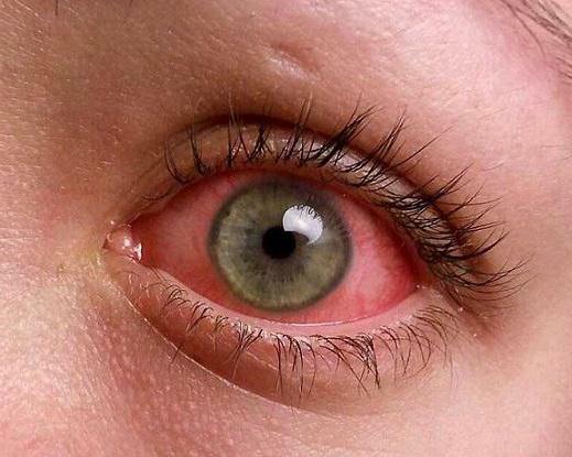 Çocuklarda gözlerin kızarması: tedavinin nedenleri ve yolları