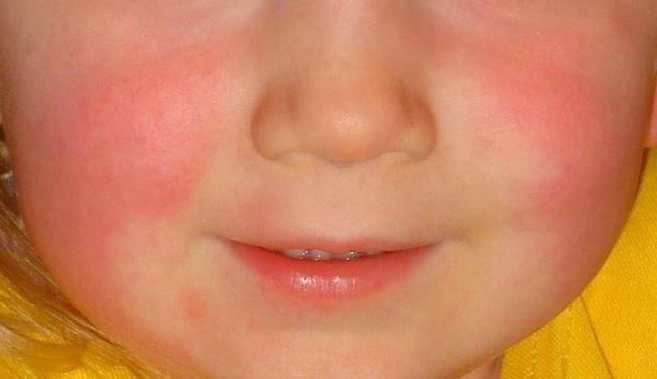A large red spot on the child