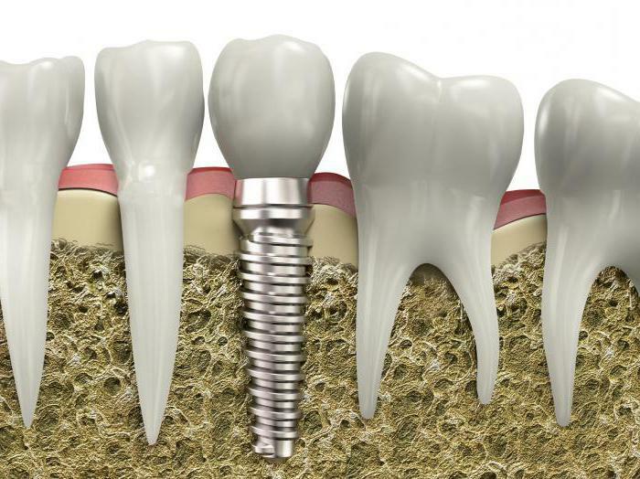 problems with dental implants