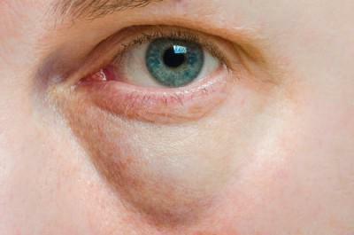 Edema under the eye of the cause on one side